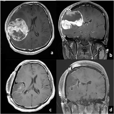 Recurrent glioblastoma metastatic to the lumbar vertebra: A case report and literature review: Surgical oncology